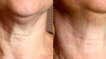 Peeling